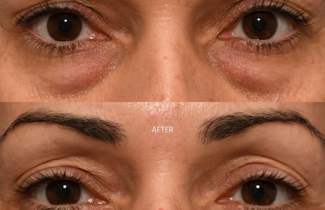 What Treats Eye Bags Best in Islamabad